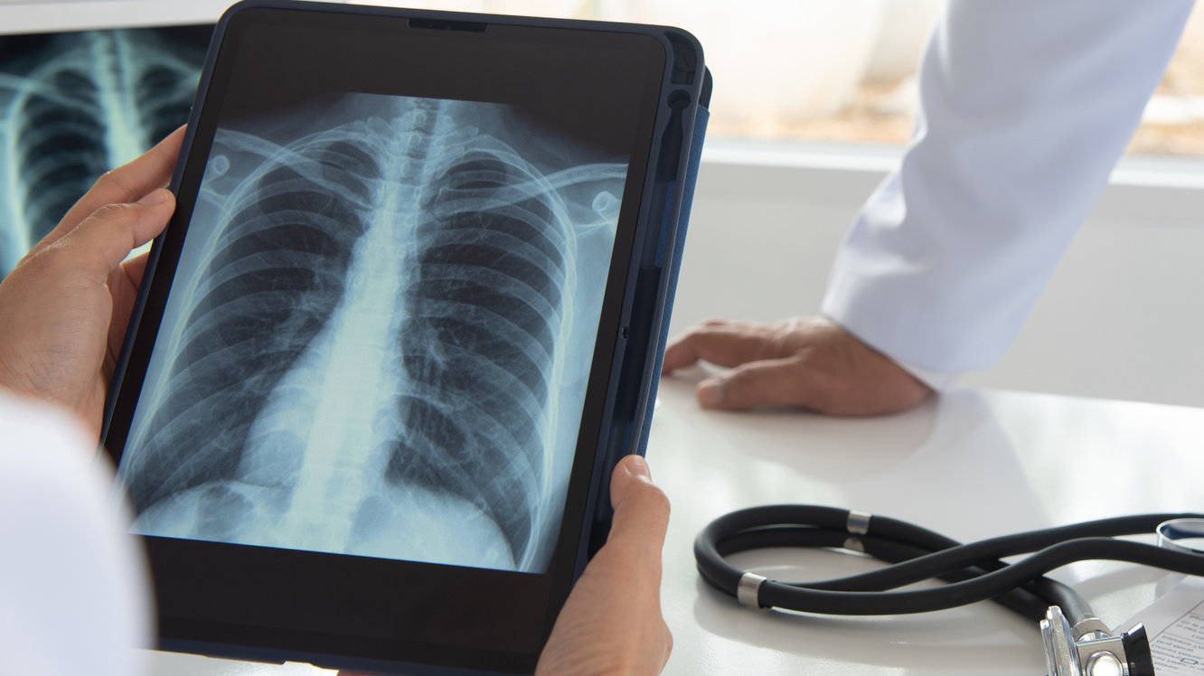 Amfizem Nedir? Amfizem Belirtileri Nelerdir?