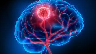 Anevrizma Nedir? Beyin Anevrizması Belirtileri Nelerdir?