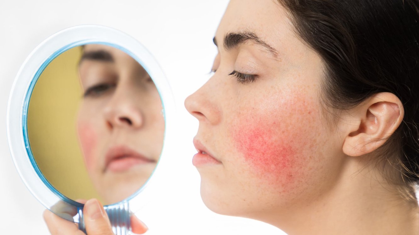 Ataksi Telenjiektazi Nedir? Ataksi Telenjiektazi Neden Olur, Belirtileri ve Tedavisi