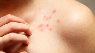 Bowen Hastalığı Nedir? Bowen Hastalığı Neden Olur, Belirtileri ve Tedavisi