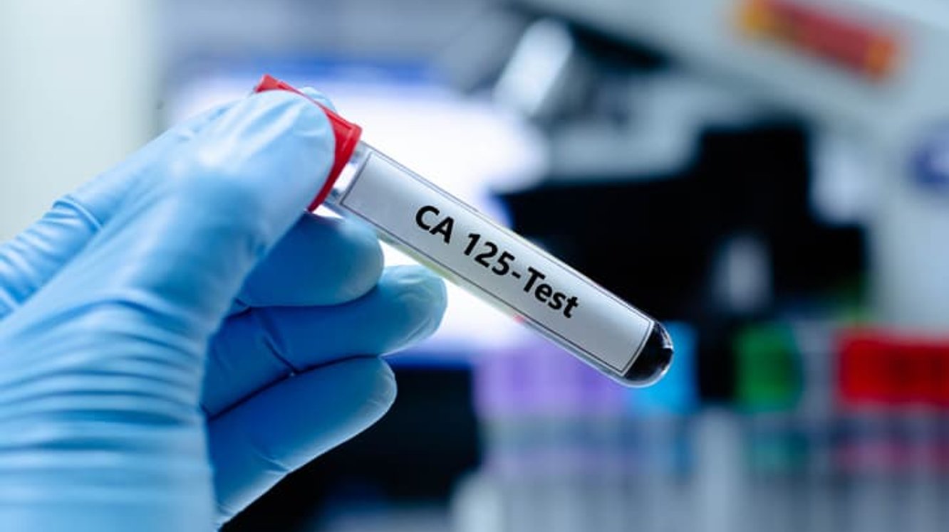 CA125 Nedir? CA125 Yüksekliği Ne Anlama Gelir?