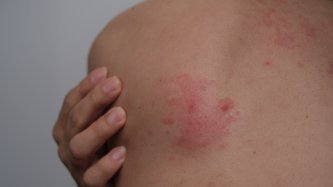 Candida Mantarı Nedir? Candida Mantarı Belirtileri, Nedenleri ve Tedavisi