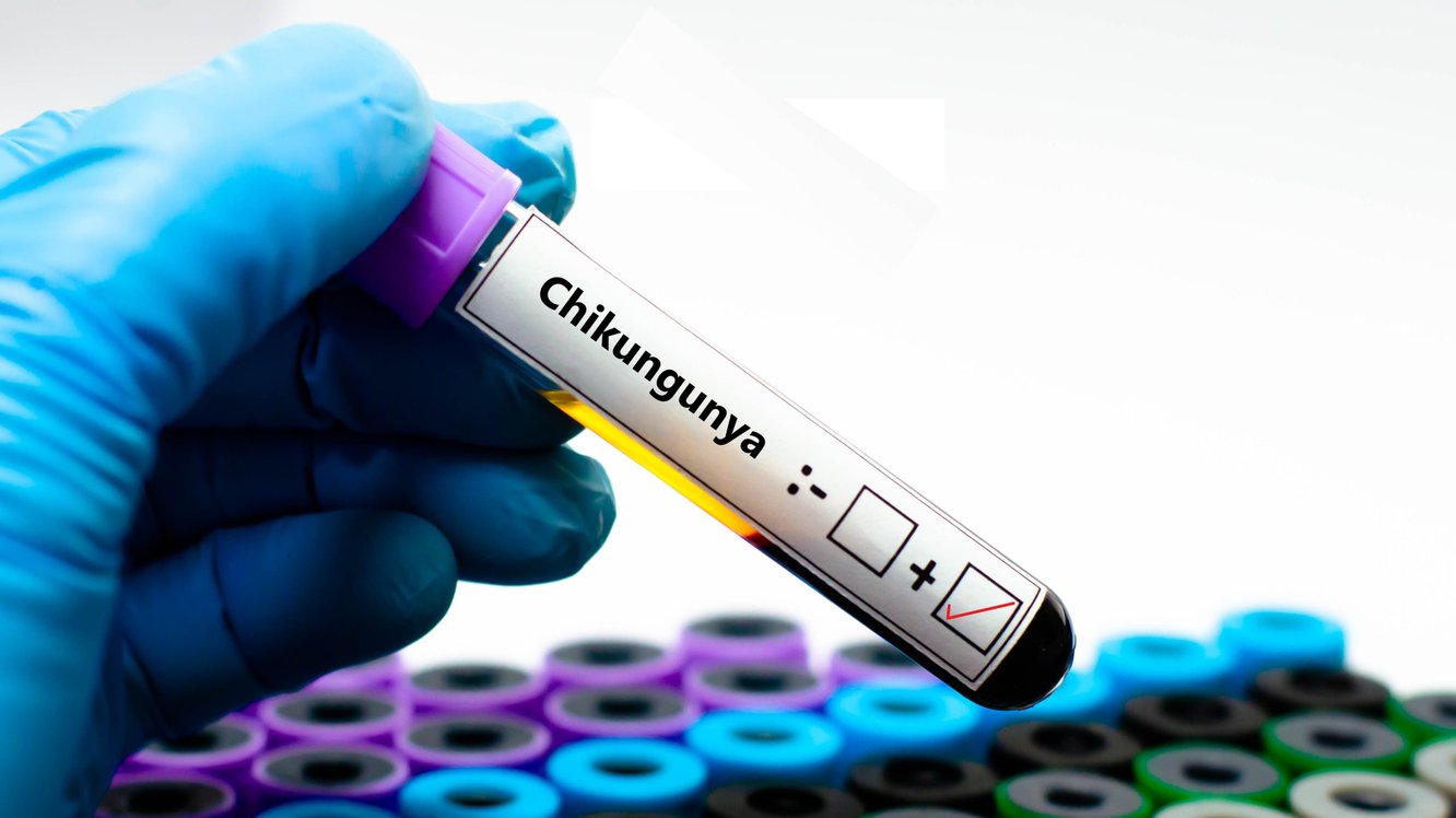 Chikungunya Virüsü Nedir? Belirtileri ve Tedavisi