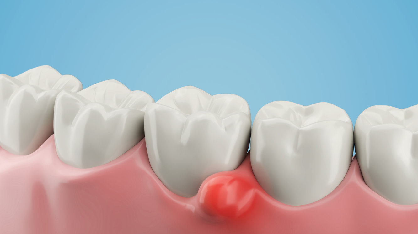 Diş Kisti Nedir? Belirtileri ve Tedavisi