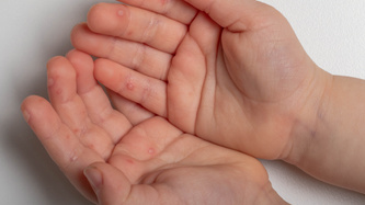 What is Hand, Foot, and Mouth Disease? Symptoms, Diagnosis, and Treatment