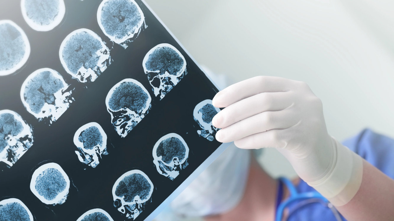 Epilepsi (Sara) Nedir? Belirtileri ve Tedavisi