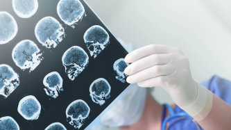 Epilepsi (Sara) Nedir? Belirtileri ve Tedavisi