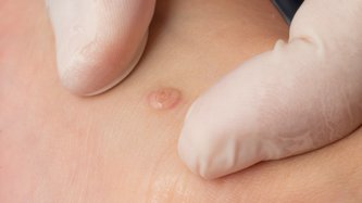 Eritema Multiforme Nedir? Eritema Multiforme Neden Olur, Belirtileri ve Tedavisi