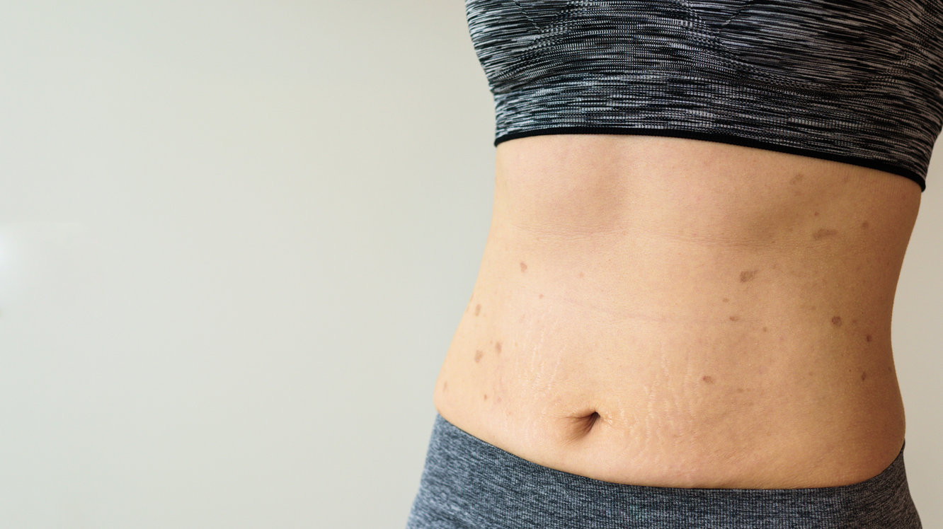 Göbek Düşmesi Nedir? Nedenleri, Belirtileri ve Tedavisi