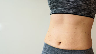 Göbek Düşmesi Nedir? Nedenleri, Belirtileri ve Tedavisi