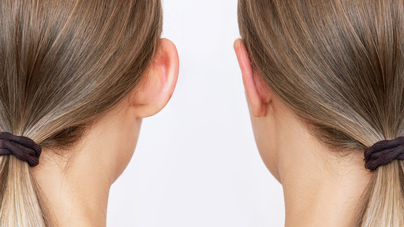 Kepçe Kulak Ameliyatı (Otoplasti) Nedir? Belirtileri ve Tedavisi