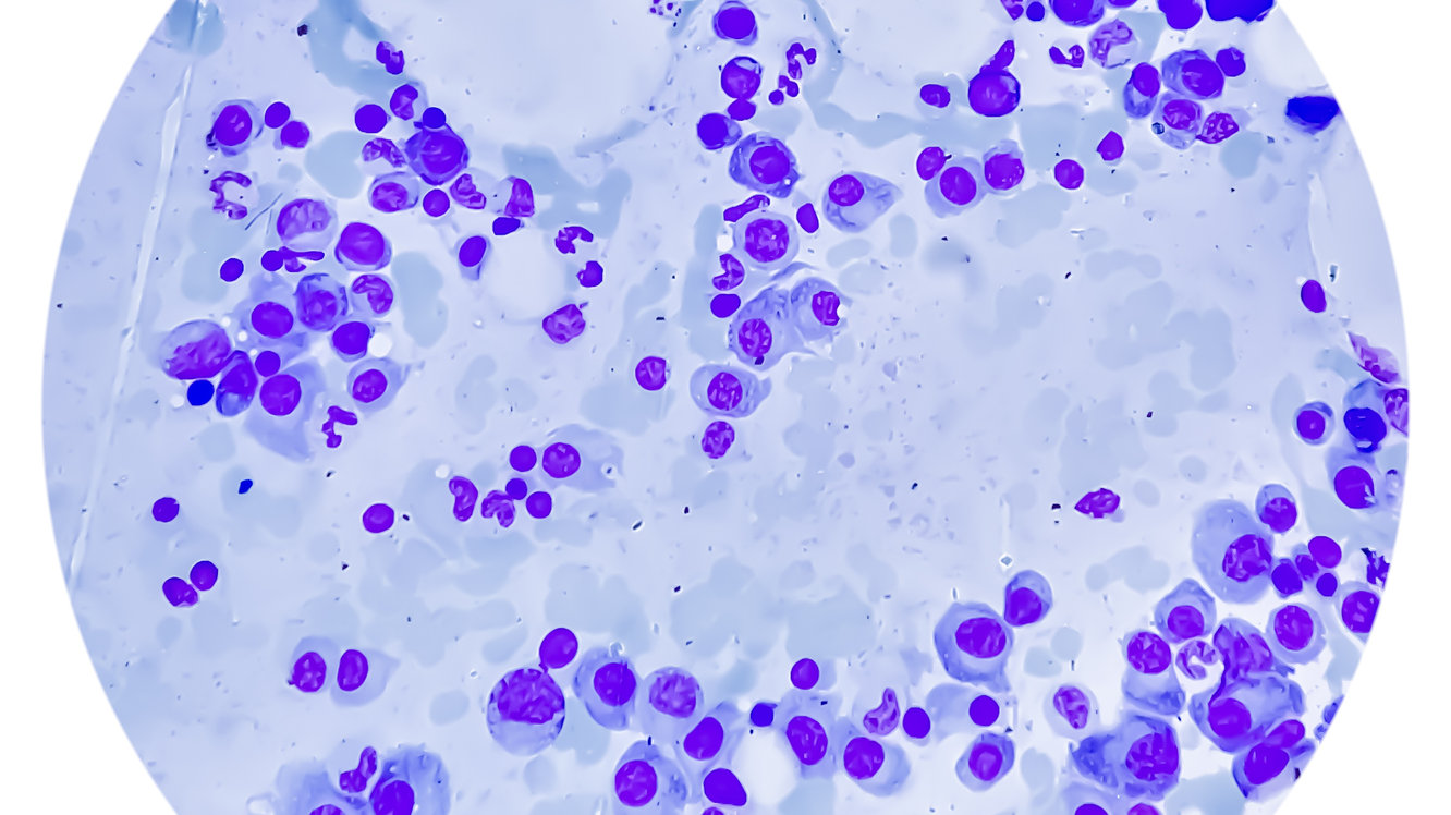 Multiple Myeloma