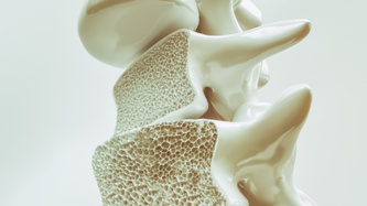 Osteoporoz (Kemik Erimesi) Nedir, Belirtileri Nelerdir?