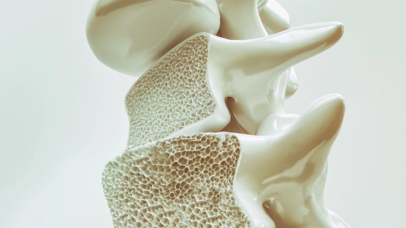 Osteoporoz (Kemik Erimesi) Nedir, Belirtileri Nelerdir?