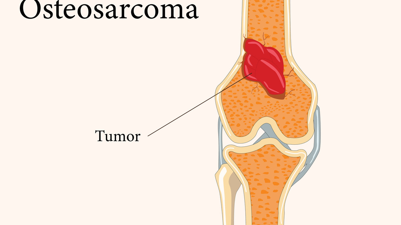 Osteosarkom Nedir? Belirtileri ve Tedavisi