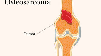 Osteosarkom Nedir? Belirtileri ve Tedavisi