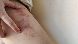 Purpura Nedir?