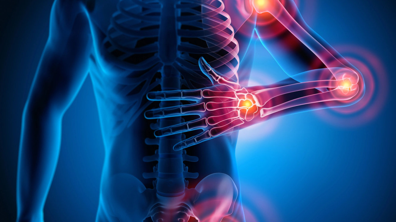 Romatoid Artrit (İltihaplı Romatizma) Nedir? Belirtileri Nelerdir?