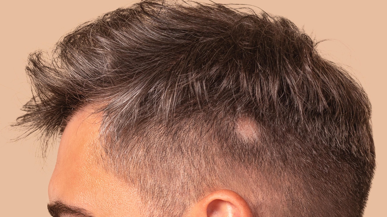 Saçkıran Nedir? Saçkıran Belirtileri ve Tedavisi