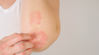 Sedef Hastalığı (Psoriasis) Nedir? Belirtileri Nelerdir?