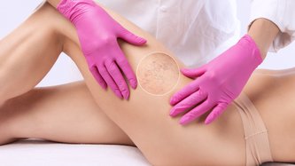 Skleroterapi Nedir? Skleroterapi Neden Olur, Belirtileri ve Tedavisi