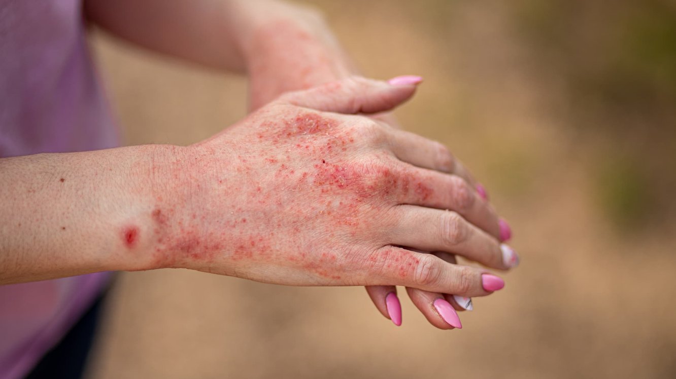 Tinea Corporis Nedir? Tinea Corporis Neden Olur, Belirtileri ve Tedavisi
