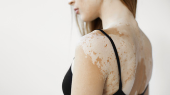 Vitiligo Hastalığı Nedir? Nedenleri ve Tedavi Yöntemleri Nelerdir?