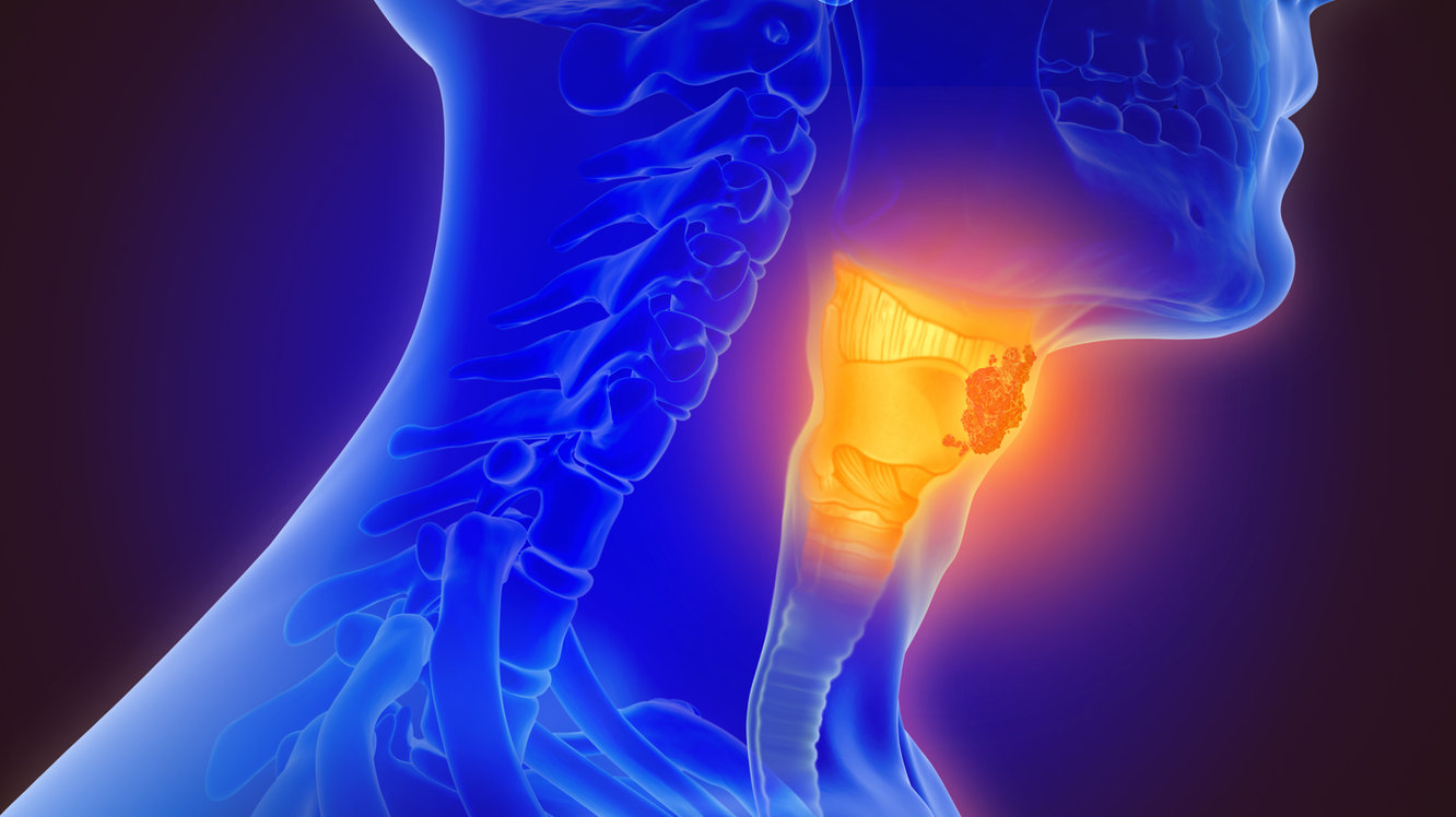 What Is a Thyroid Nodule? Symptoms, Causes, and Treatment