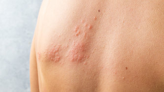 Yılancık Hastalığı (Erizipel) Nedir? Belirtileri ve Tedavisi